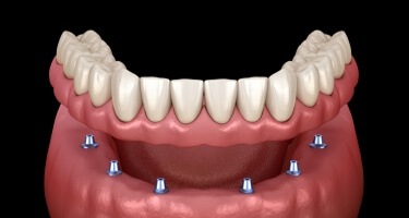 Illustration of a full denture being supported by six dental implants