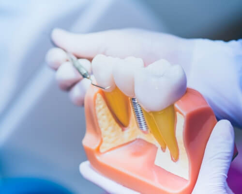 Dentist holding a model of a dental implant in the lower jaw