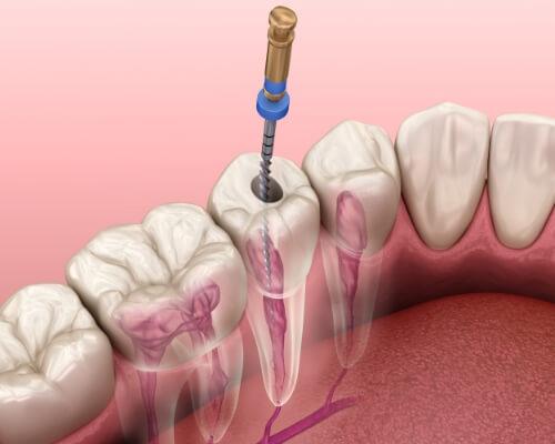 Illustration of a thin dental instrument treating the innermost layer of a tooth